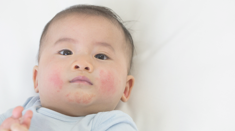 Kan olijfolie irritaties of eczeem bij baby's veroorzaken?