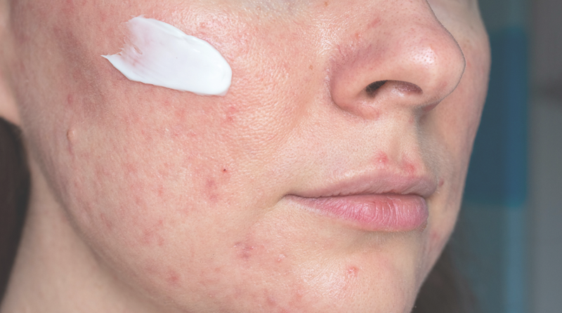 De beste huidverzorging tips voor rosacea