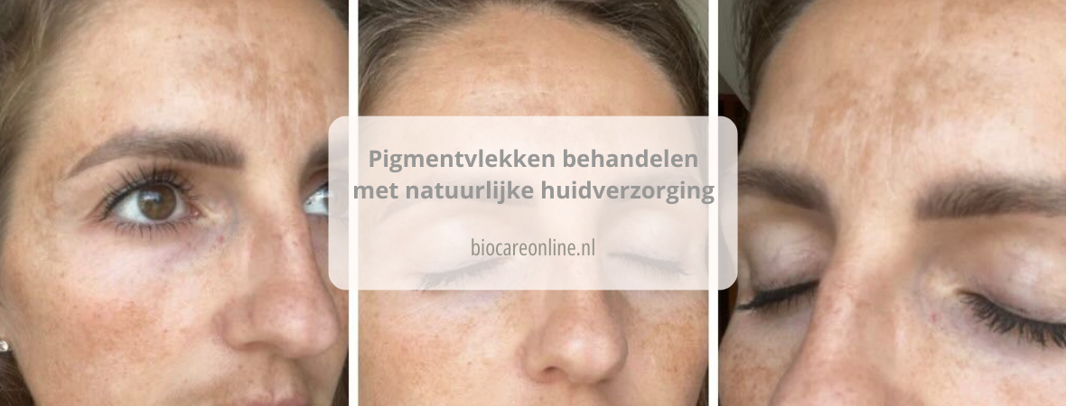 Pigmentvlekken behandelen met natuurlijke huidverzorging